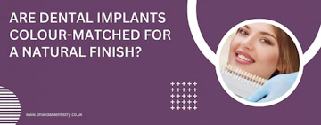 Are dental implants colour-matched for a natural finish
