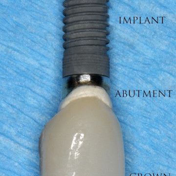 single crown implant