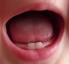 toddlers mouth with 2 small teeth