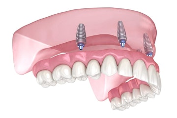Denture Retained Implants Diagram