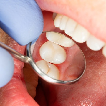 root canal procedure Coventry