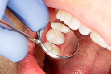 root canal procedure Coventry