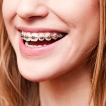 girl with metal braces smiling