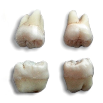 4 extracted wisdom teeth